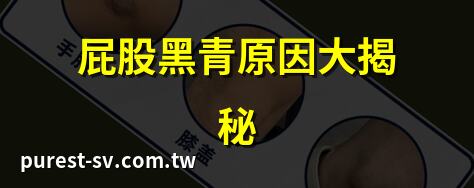 屁股黑青原因大揭秘 | 屁股黑青怎麼辦？專家解答 | 屁股黑青快速消除法 | 屁股黑青的治療秘訣