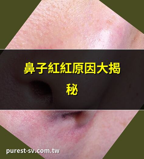 鼻子紅紅原因大揭秘 | 鼻子紅紅如何快速消紅 | 鼻子紅紅是否代表疾病 | 鼻子紅紅與飲食的關聯
